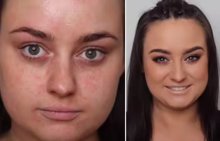 How To Hide Eczema With Makeup How To Hide Pimples With Makeup - How To Hide Eczema With Makeup
