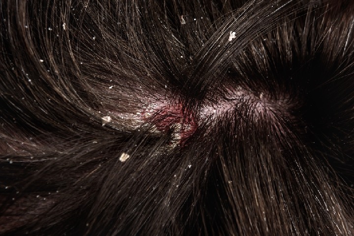 ezcema dandruff 1 Skin disease on scalp