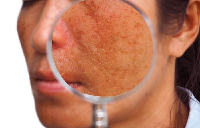 1. Melasma