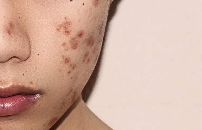 2. Post- Inflammatory Hyperpigmentation (PIH)