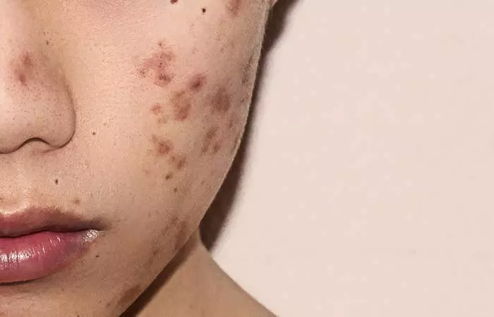 2. Post- Inflammatory Hyperpigmentation (PIH)