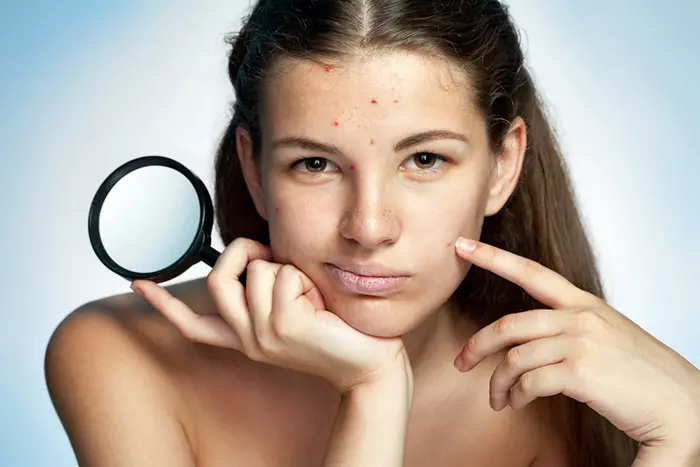 Food for Acne-Prone Skin