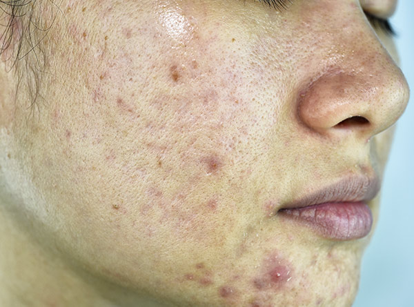 Acne Vulgaris