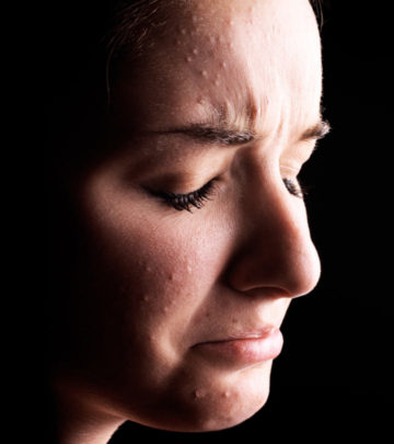 Adult Acne – Causes, Symptoms, And Treatments_image