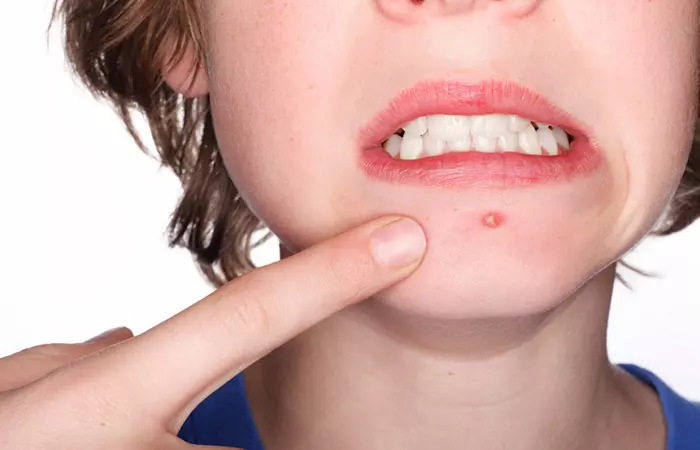 What Causes Adult Acne Factors Responsible For It