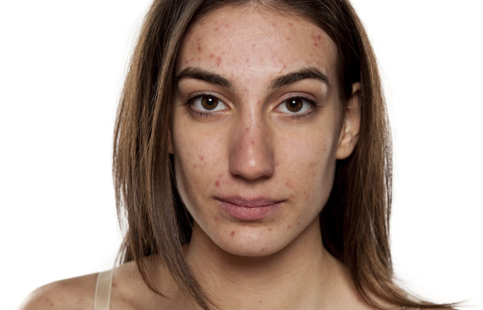 What Is Adult Acne And How Is It Different From Teenage Acne