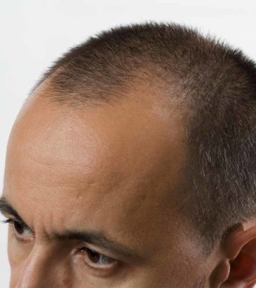 Best Hair Transplant Centers In Hyderabad - Our Top 10