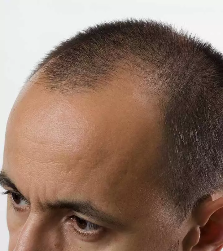 Best Hair Transplant Centers In Hyderabad - Our Top 10