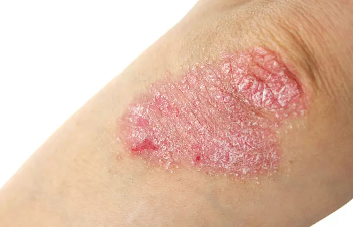 5. Bath Salts For Psoriasis