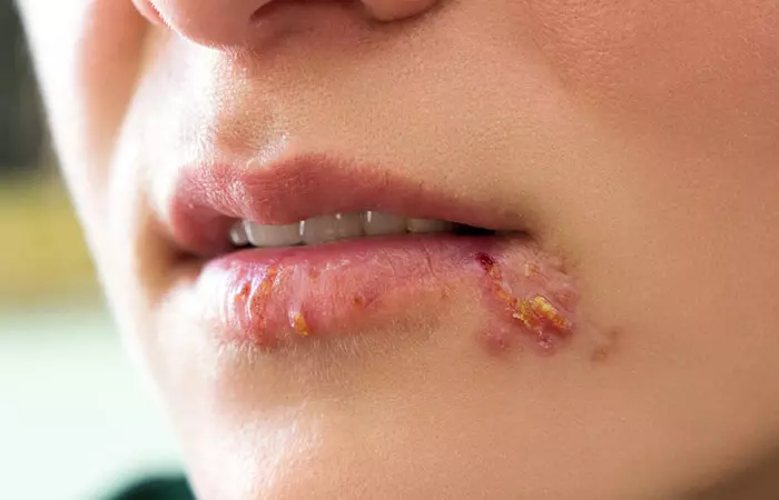 Cold Sores And Pimples