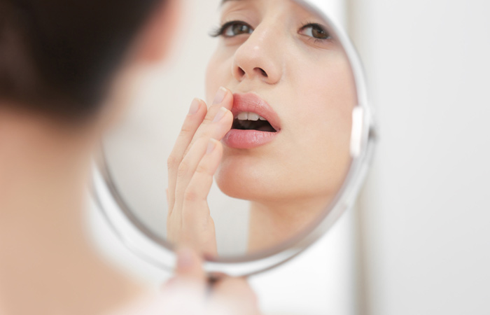 Cold Sores Vs. Pimples
