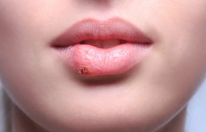 Ways To Treat Cold Sores