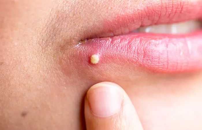 Ways To Treat Pimples On the Lips