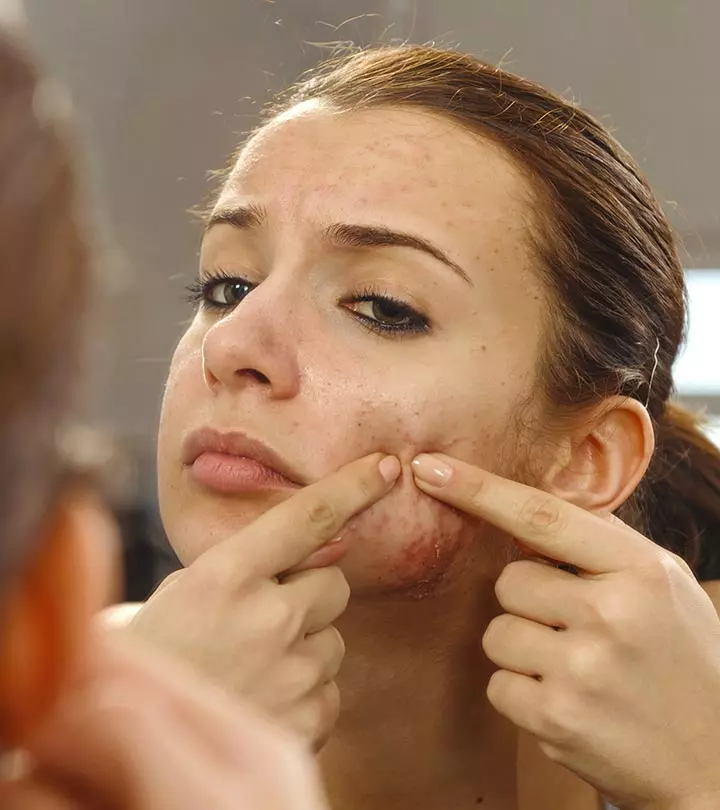 5-Simple-But-Very-Effective-Acne-Vulgaris-Treatments