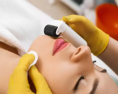 Dermaroller Treatment At The Clinic For Acne Scars