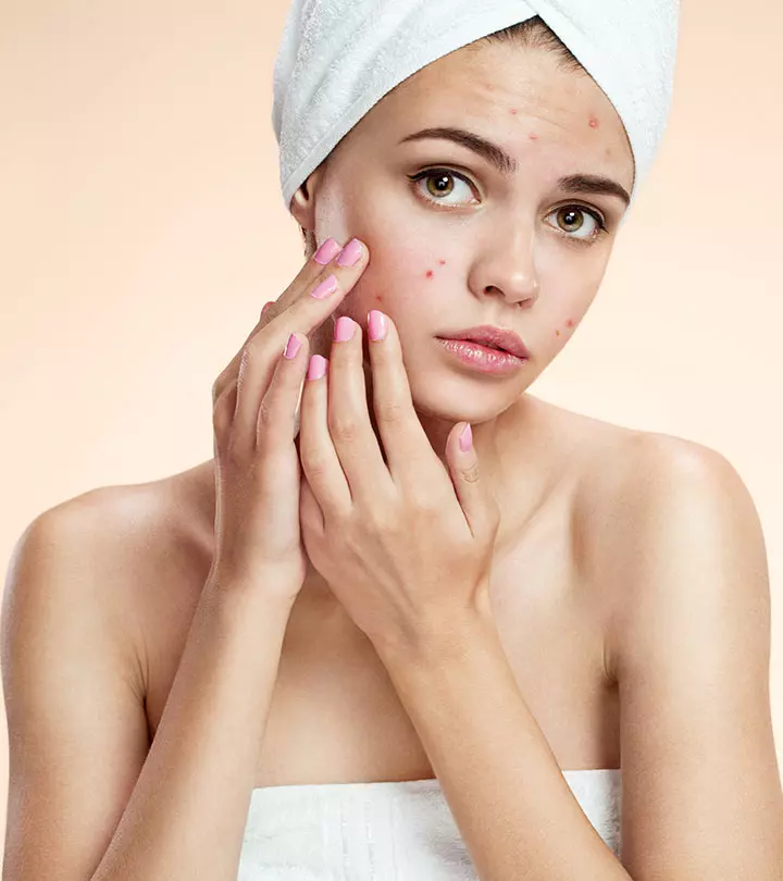 Different Types Of Acne And How To Treat Them Effectively