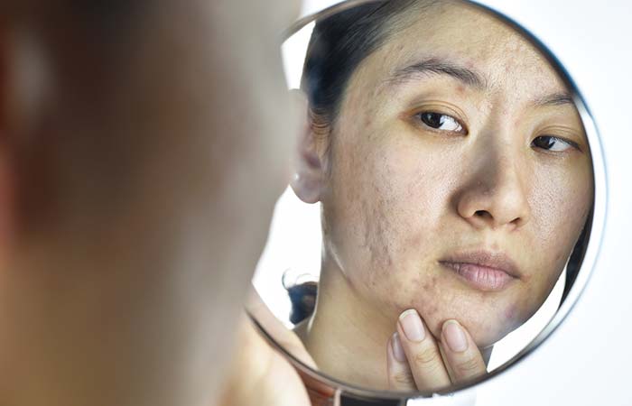 Services for acne and acne scars at Kaya Services for acne and acne scars at Kaya