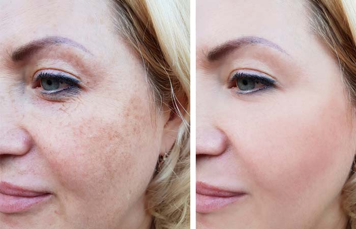 Beauty services at Kaya Skin Clinic for pigmentation Beauty services at Kaya Skin Clinic for pigmentation