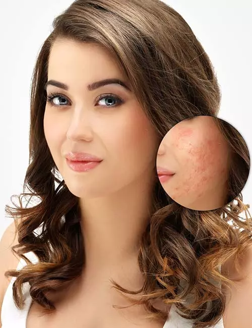 What Is The Dermaroller Treatment For Acne Scars