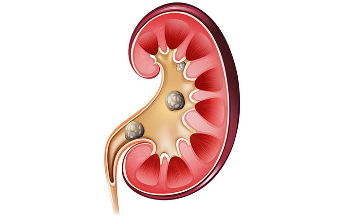 What Are Kidney Stones