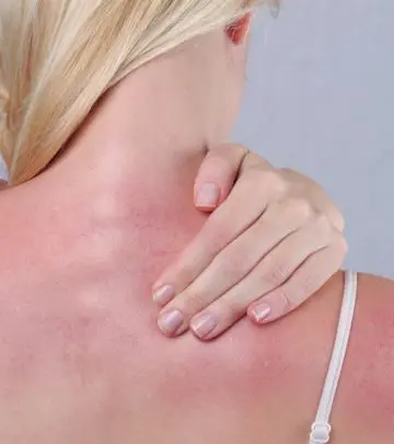 How To Get Rid Of Sunburn Blisters_image