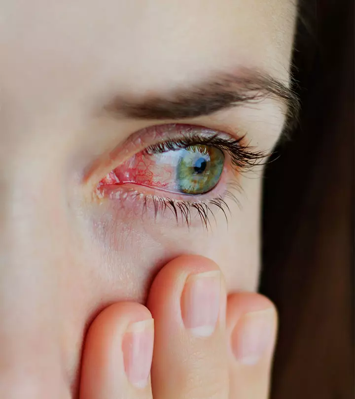 Pink Eye (Conjunctivitis) – Types, Causes, Symptoms, And Natural Treatment Options_image