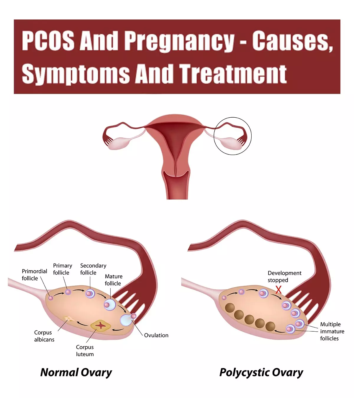 PCOS And Pregnancy: Causes, Symptoms And Treatment_image