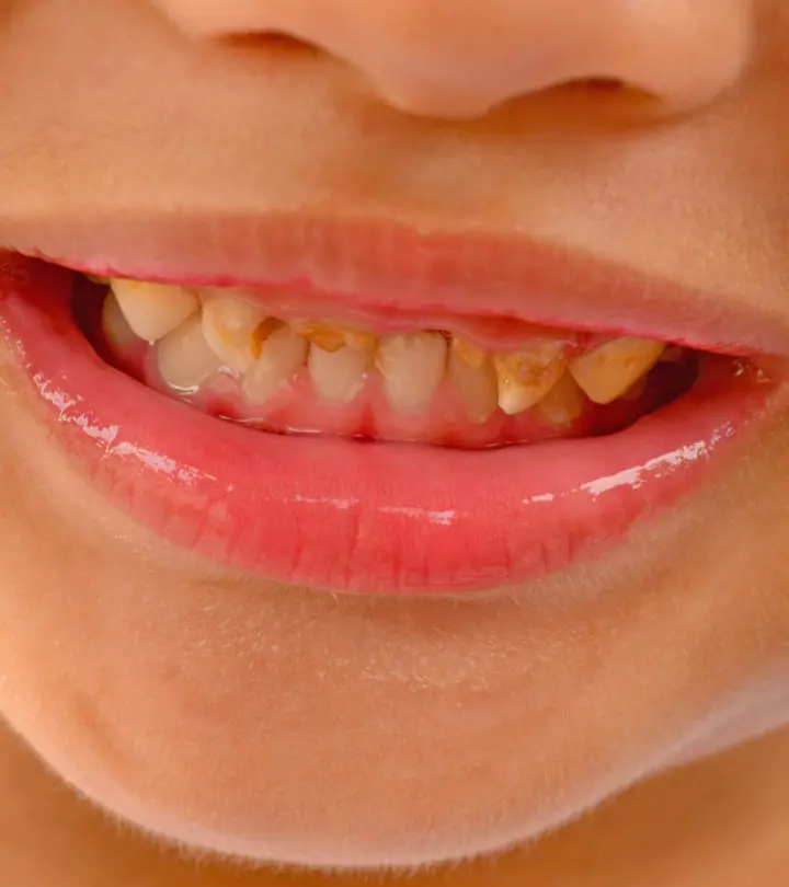 Bruxism In Kids – Causes, Symptoms And Treatment