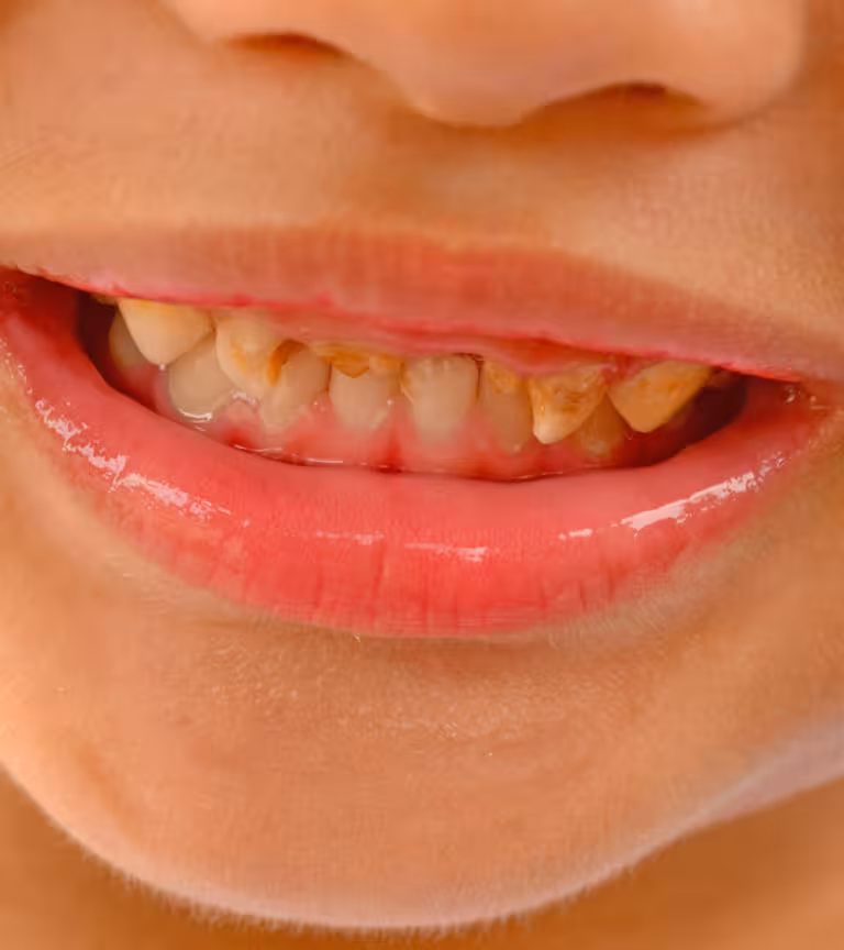 Bruxism In Kids – Causes, Symptoms And Treatment