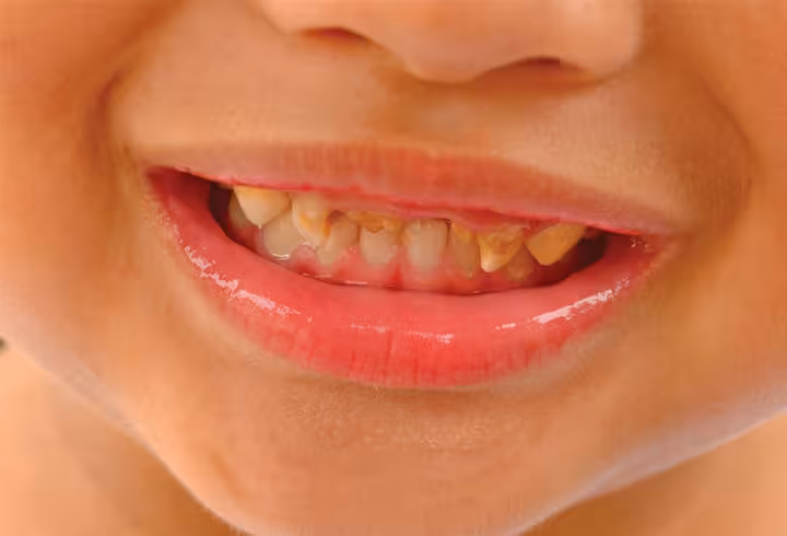 Bruxism buss