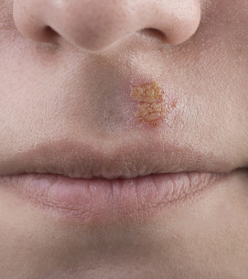 Canker Sores In Children - Causes, Treatment And Remedies