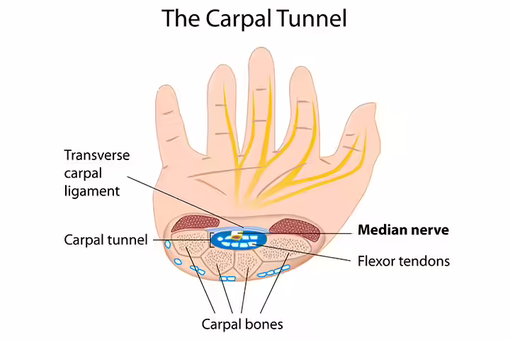 What Is Carpal Tunnel Syndrome What Is Carpal Tunnel Syndrome
