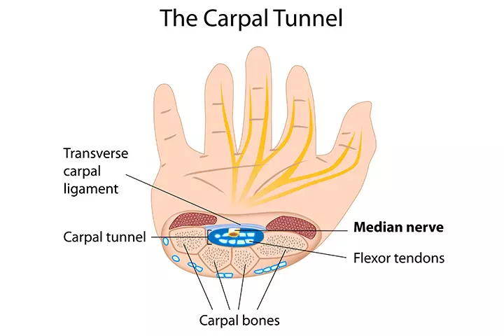 What Is Carpal Tunnel Syndrome