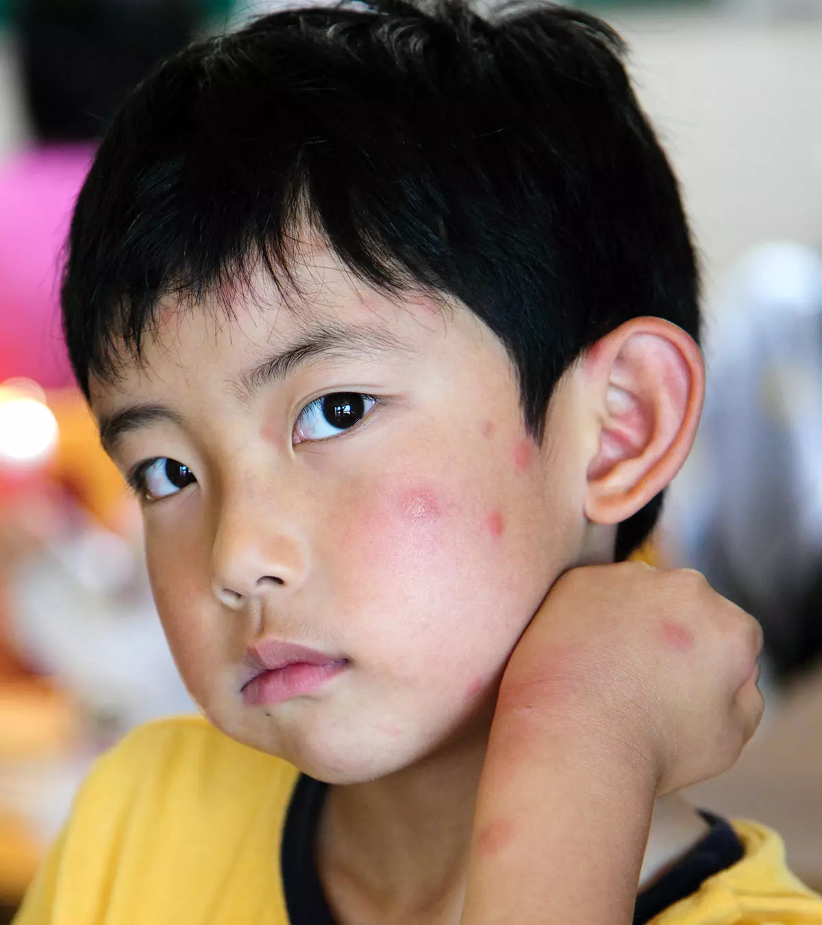 3 Simple Steps To Treat Insect Bites In Children_image