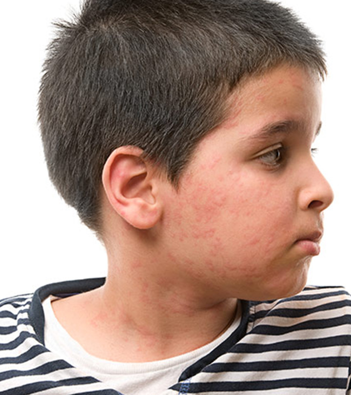 Eczema In Children – Causes, Symptoms And Treatment_image