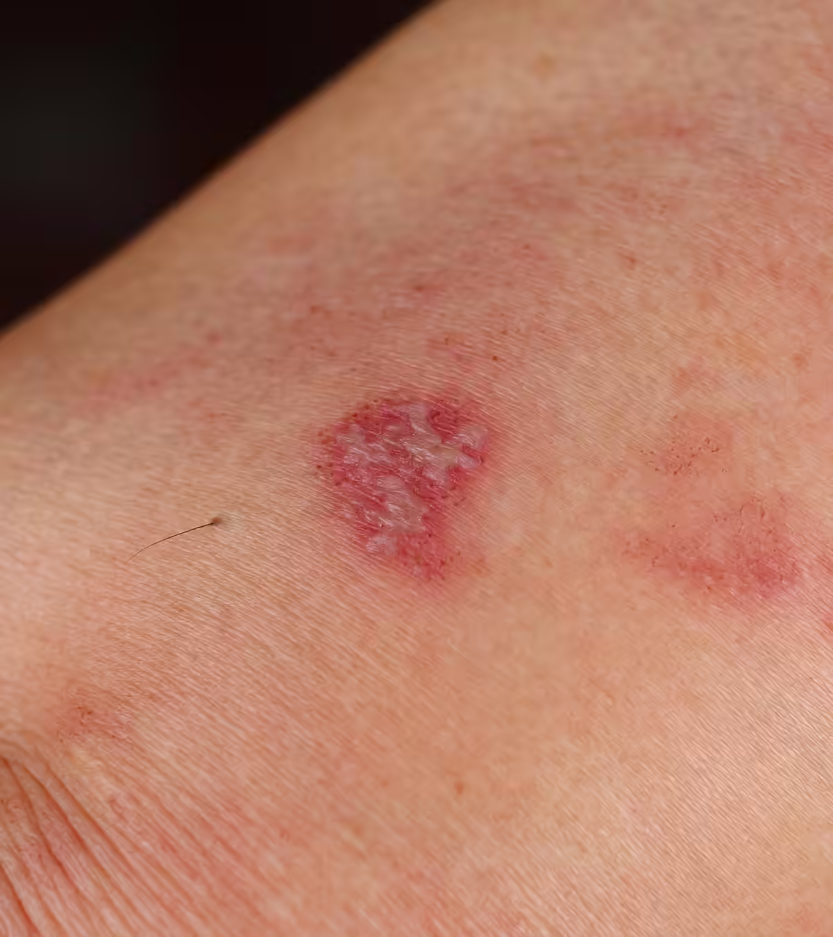 Exposure To Shingles While Pregnant