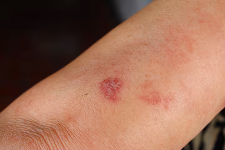 Exposure To Shingles While Pregnant