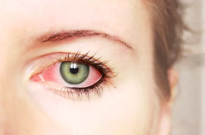 Eye-Infections