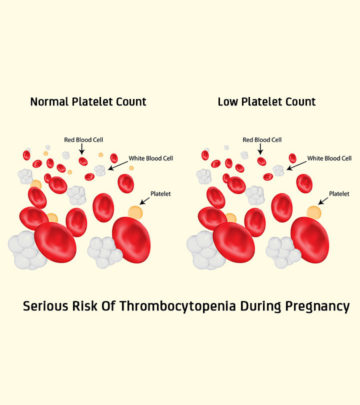 Thrombocytopenia In Pregnancy: Causes, Risks And Treatment_image