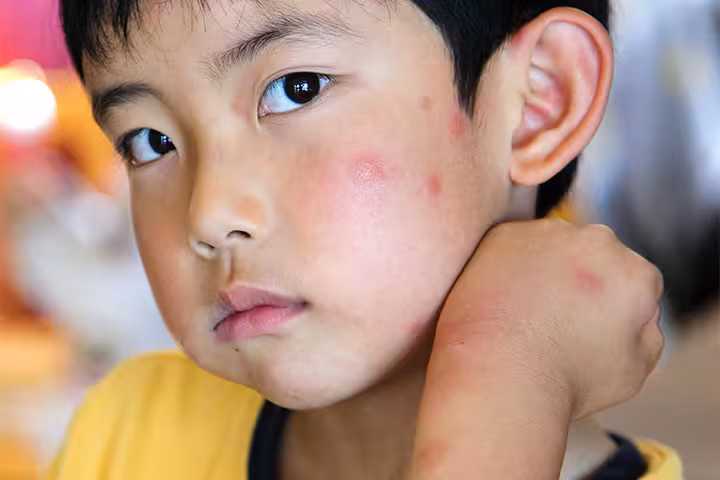 Insect Bite Allergy 3 simple steps to treat itchy insect bites at home