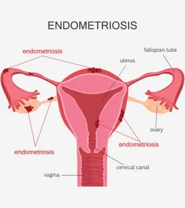 Is It Possible To Get Pregnant With Endometriosis?_image