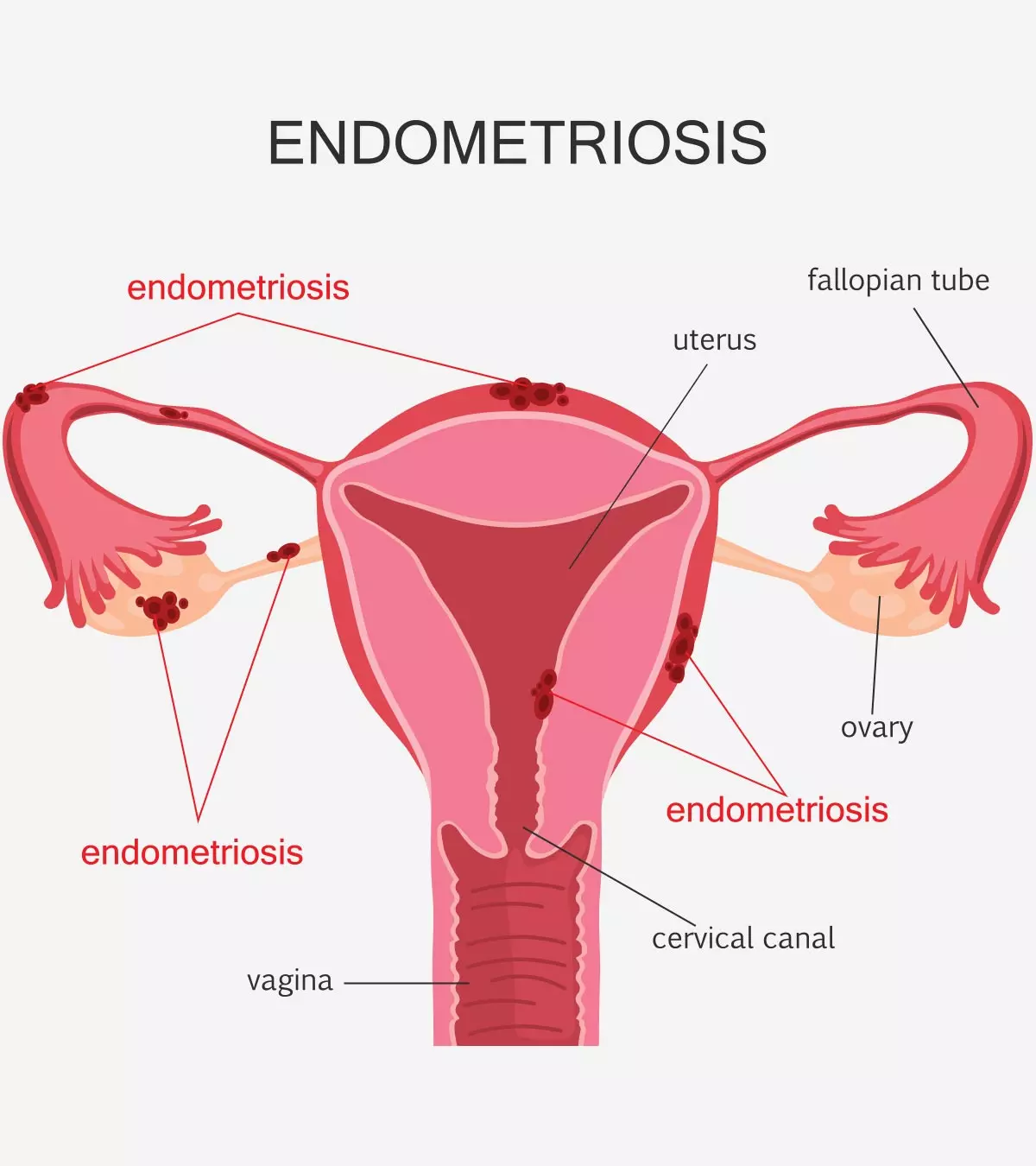 Is It Possible To Get Pregnant With Endometriosis?_image