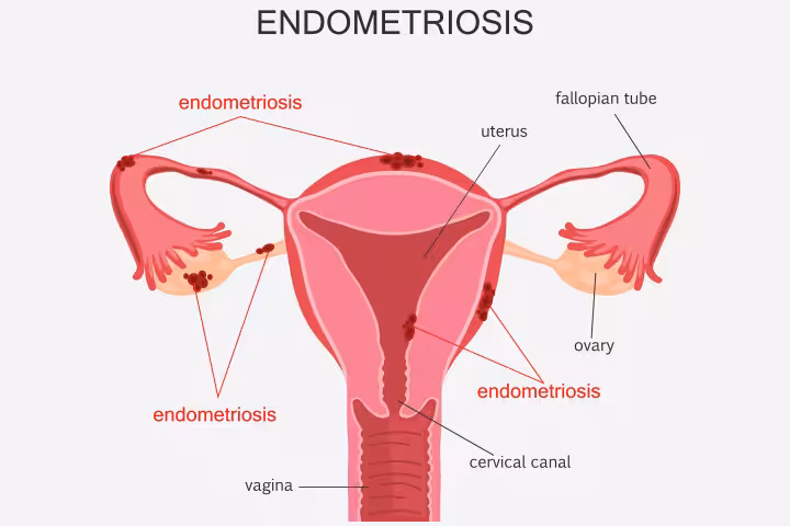 Can You Get Pregnant With Endometriosis Can You Get Pregnant With Endometriosis