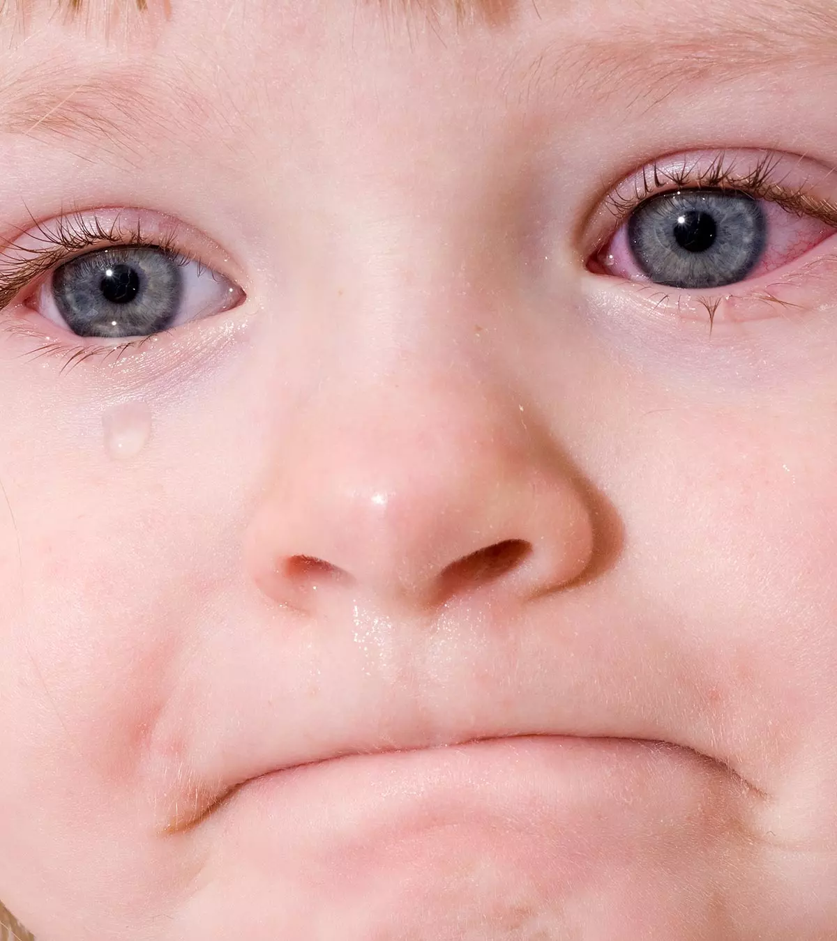 Pink Eye (Conjunctivitis ) In Toddlers – 3 Causes, 8 Symptoms & 4 Treatments You Should Be Aware Of_image