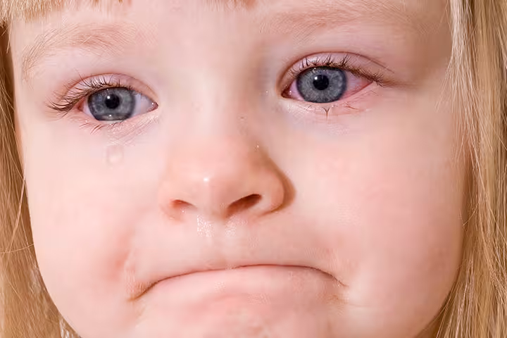 Pink Eye In Toddlers pink eye in toddler