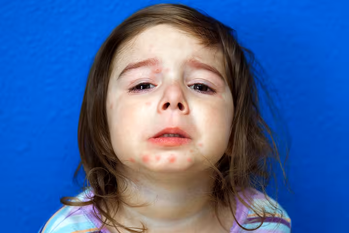 14 Effective And Soothing Treatments Of Psoriasis In Children