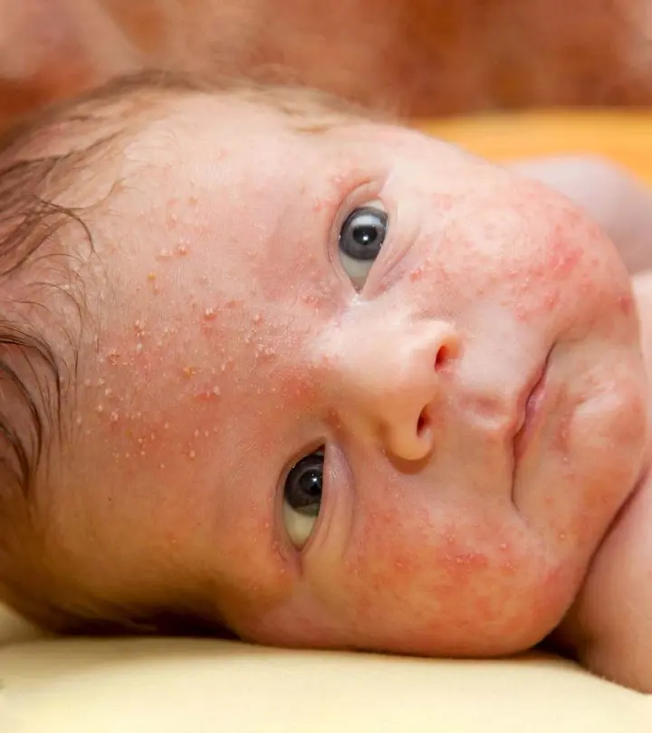 4 Simple Steps To Treat Burns In Infants Babies