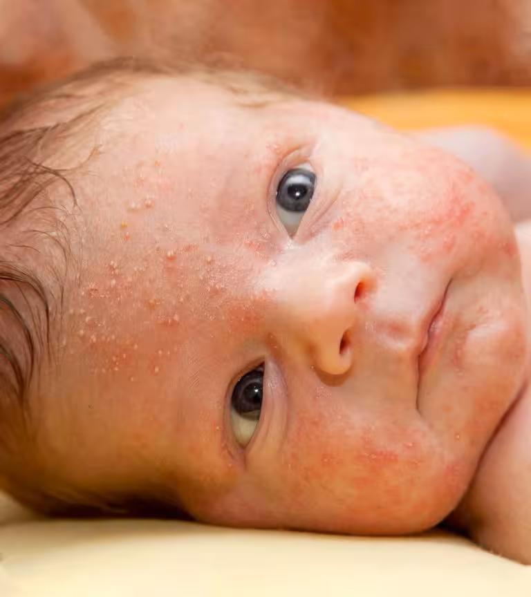 4 Simple Steps To Treat Burns In Infants Babies