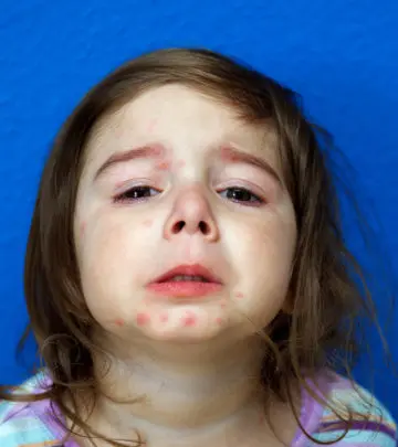 Psoriasis In Children: Types, Symptoms And Treatment_image