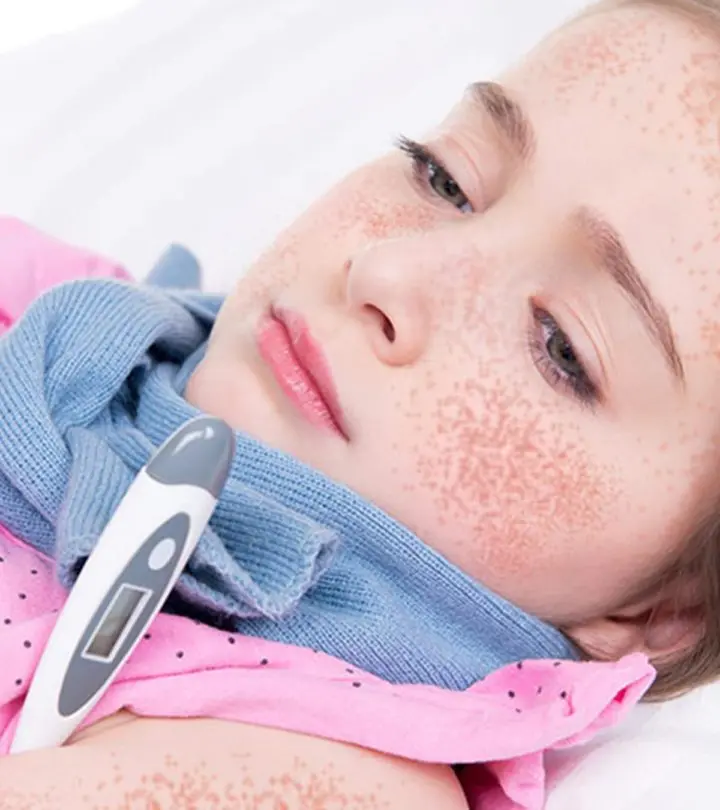 Scarlet Fever In Children Causes, Symptoms And Treatment